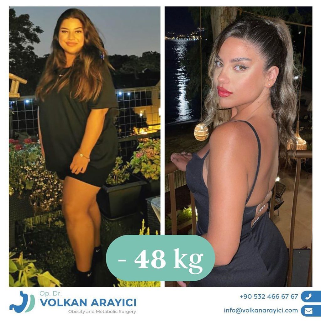 Wie viel kostet eine Magenverkleinerung? Mythen und Fakten